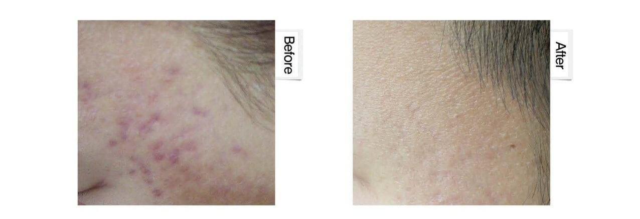 ニキビ跡の症例写真