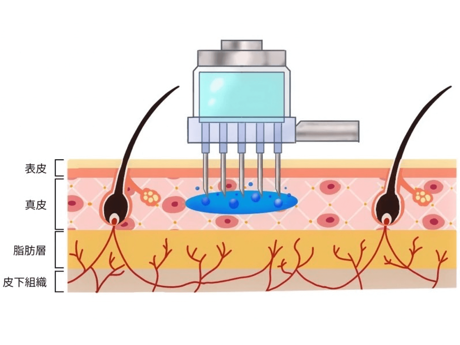 水光注射頭皮イラスト