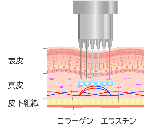 イラスト：水光注射施術（イメージ）