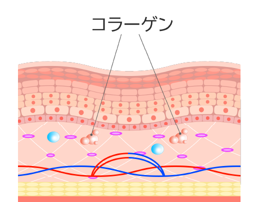 イラスト：水光注射施術（イメージ）